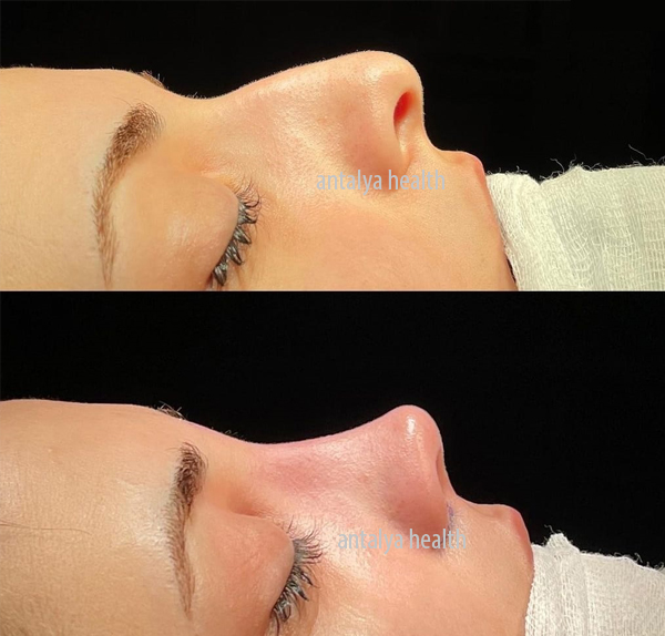 Cosmetic Surgery Turkey